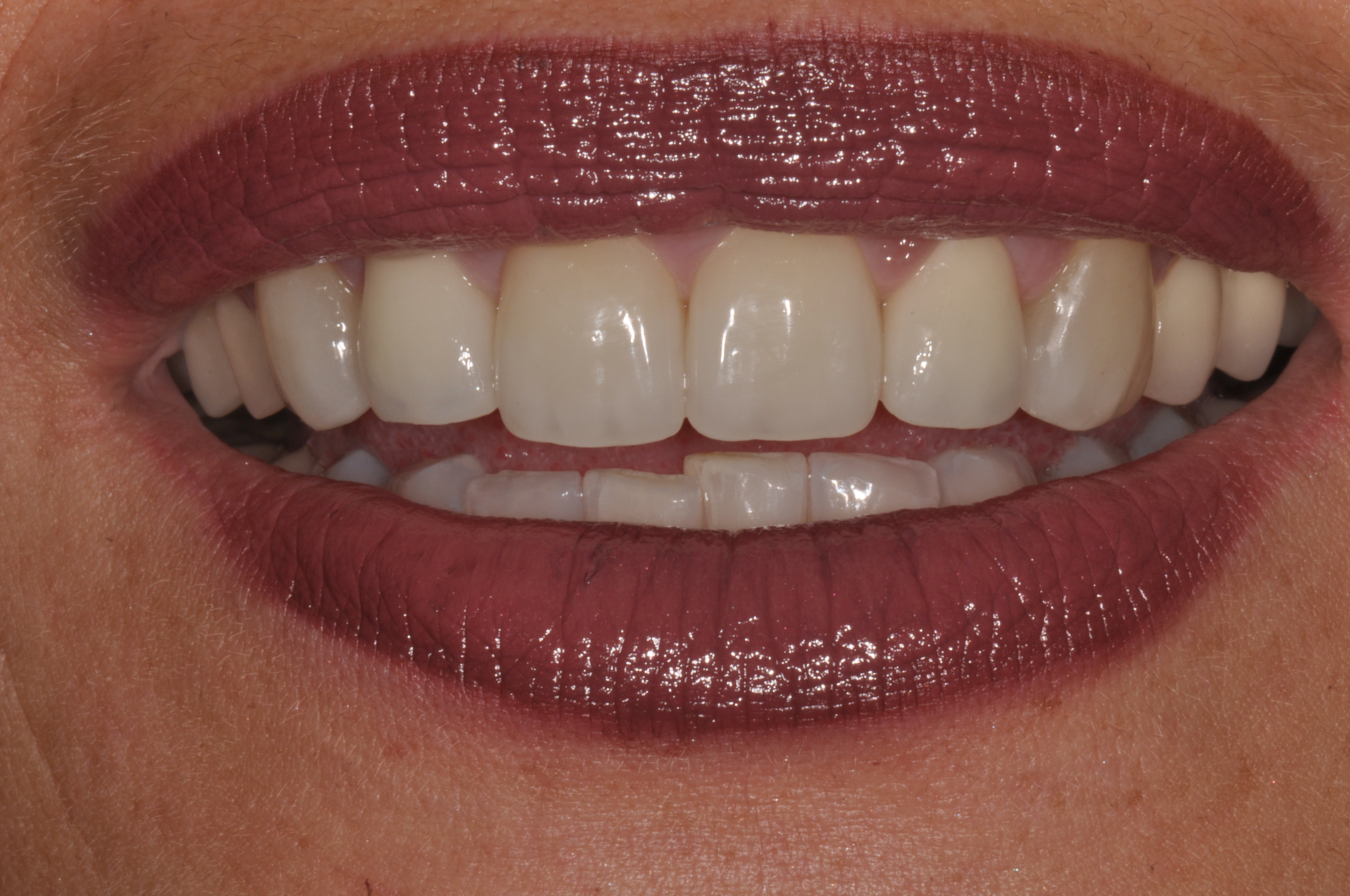 Attraktives Lächeln durch 6 Veneers und Bleaching